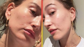 image for Hailey Bieber Goes Filter-Free and Shares Skincare Struggles